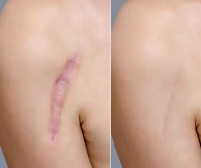 acne scar treatment.webp