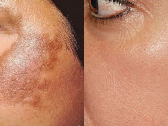 Pigmentation-Removal-In-Dehradun-570x430.jpg