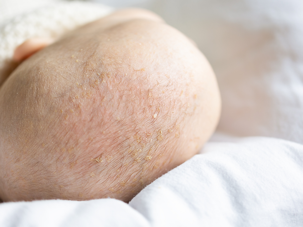 Себорейний дерматит у немовлят: чи потрібно вичісувати «кірочки» і коли це ознака алергії