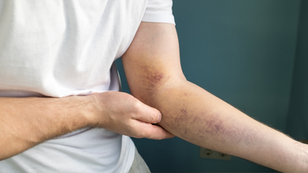 Синці, які беруться нізвідки: варто хвилюватися?