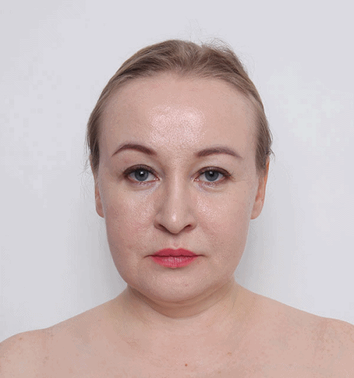 Ultherapy treatment being performed by a Korean dermatologist