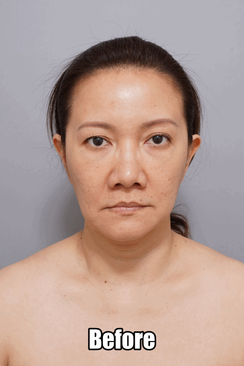 face lifting before & after