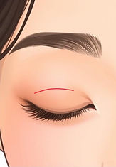 Illustrations showing the step-by-step procedures of eye surgery - Incision