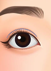 Illustrations showing the step-by-step procedures of eye surgery - Recovery