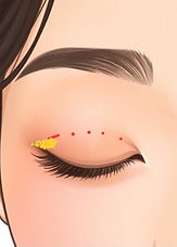 Illustrations showing the step-by-step procedures of eye surgery - Fat removal