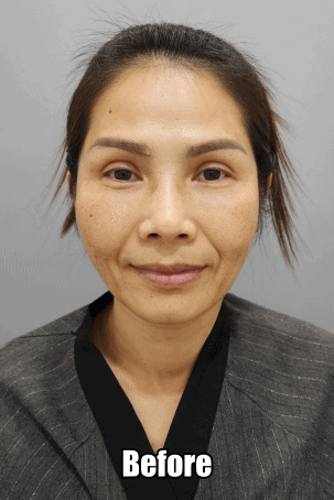 face lifting before & after