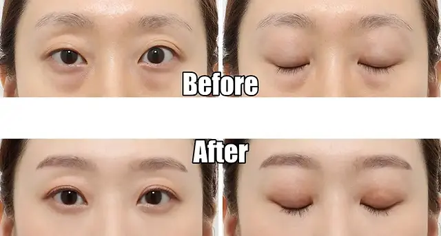 plastic surgery in Korea for foreigners