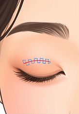 Illustrations showing the step-by-step procedures of eye surgery - Suturing