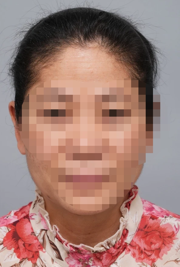 before sub brow lift