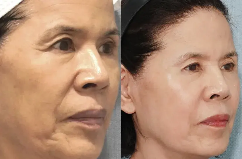 Before and after anti-aging laser result