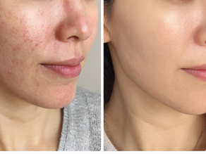 Before and after skin treatment result