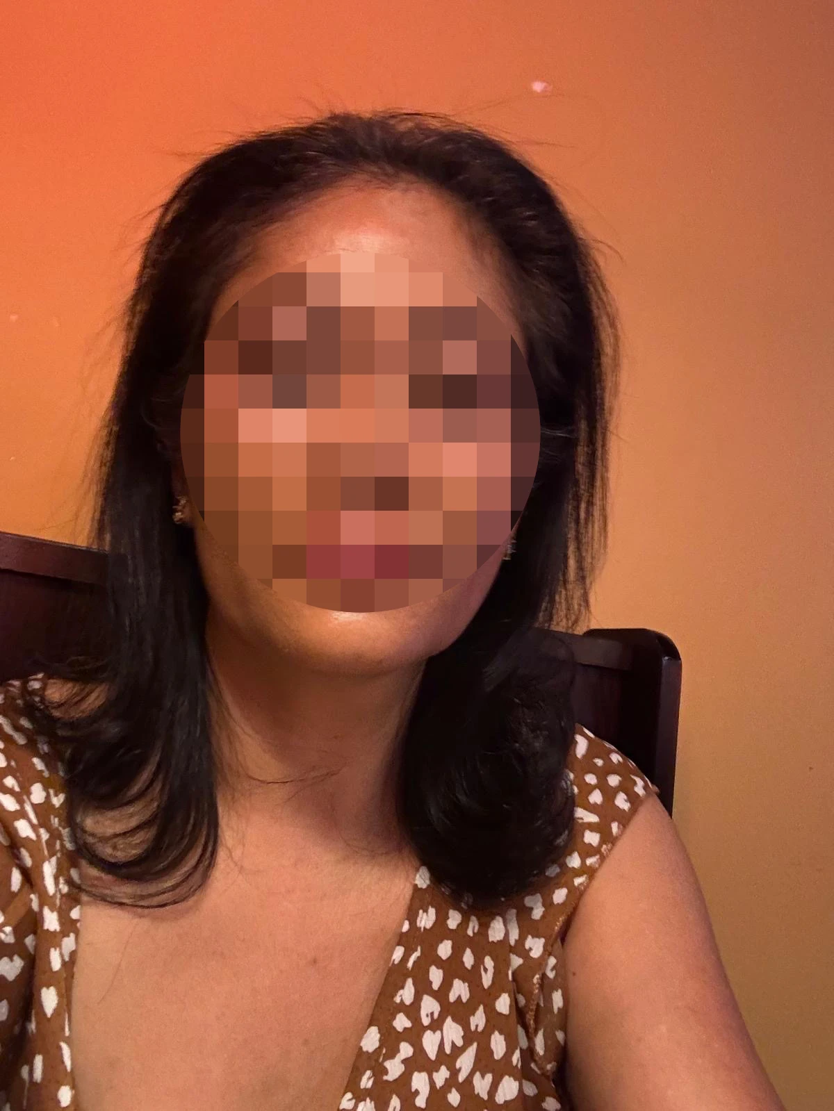 3months after sub brow lift