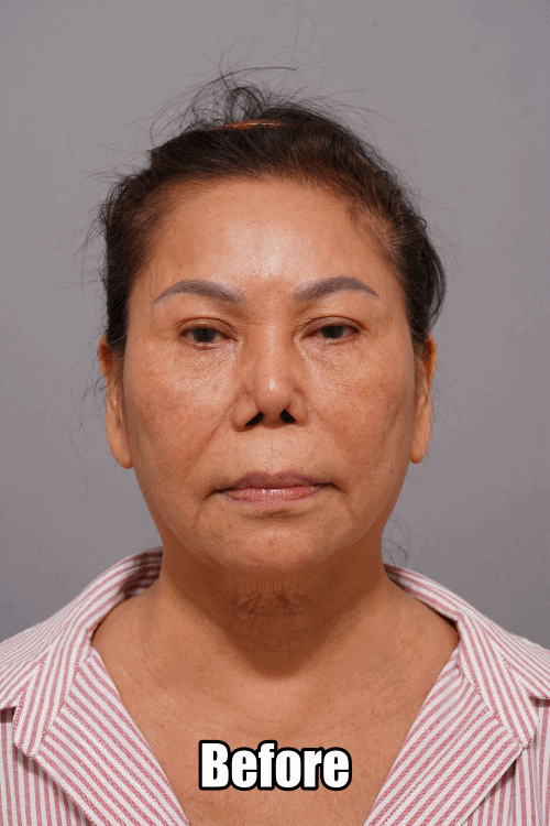 face lifting before & after