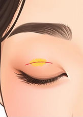 Illustrations showing the step-by-step procedures of eye surgery - Fat removal