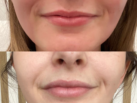 Lip Flip vs Lip Filler: Which Lip Treatment Is Best?