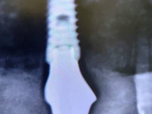 Abutment customizzato su impianti