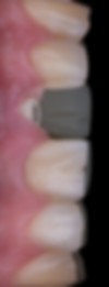 Dental implant