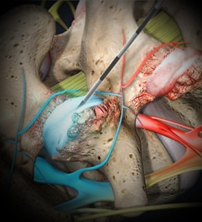 FACET JOINT INJECTIONS