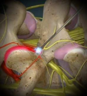 Radiofrequency Ablation