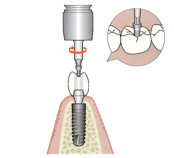 インプラント⑤.gif