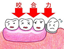義歯沈下 .jpg