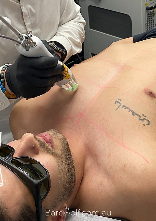 Chest Hair Removal Sydney.jpg