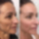 Procell Microchanneling for skin texture, tone, scarring, and firming with growth serums for cellular reproduction.