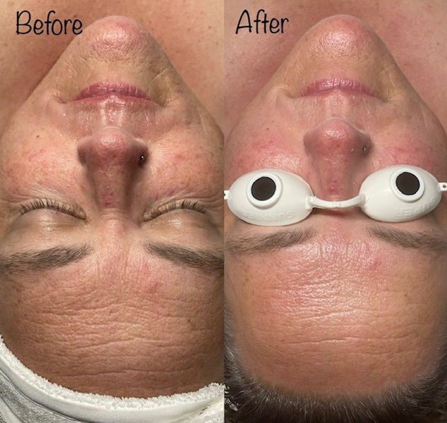 before and after picture of a clients facial, reducing fine lines and redness in her skin