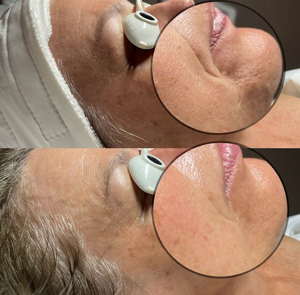 Facial treatment before & after picture of a fine line around mouth disappearing