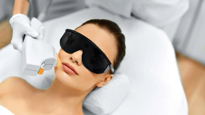 IPL photofacial