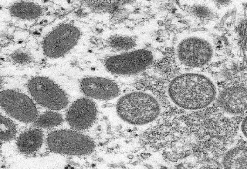 Se incrementan los casos de viruela del mono en Colombia