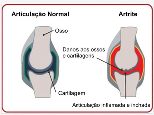 Sinergia de micronutrientes e tratamento de Artrite