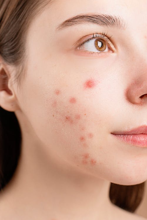 Close-up of a young woman’s face with red acne blemishes on her cheek, neutral expression against a plain background.