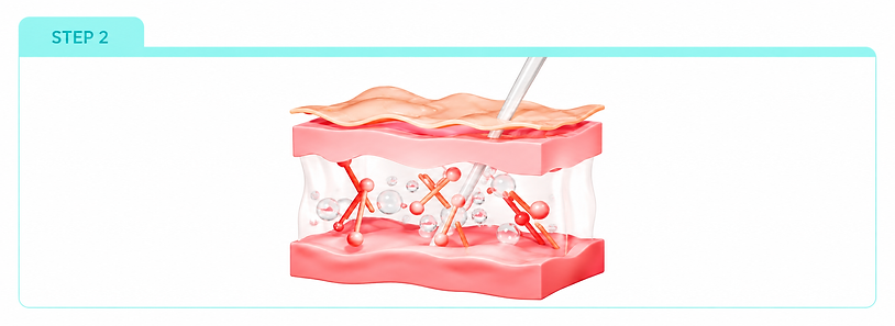 Step 2_ Dermal Injection Infographic.png