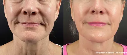 EsmeMedspa_Morpheus8_BeforeAfter_4Treatments_Front-TM.webp
