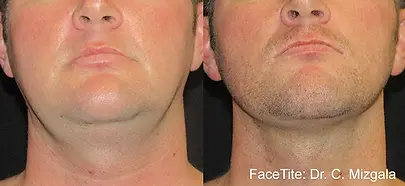 FaceTite-Before-and-After-Double-Chin.webp