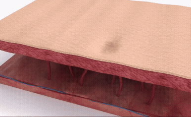 Adobe Express - curejet subcision auckland clinic (1).gif