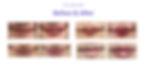 the lab clinic lip filler before and after