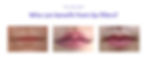 who should get lip filler auckland lab clinic