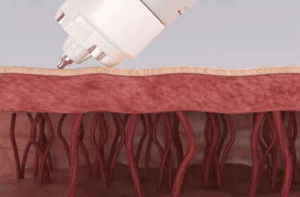 Adobe Express - curejet how it works.gif