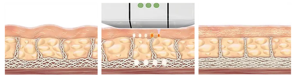 Ultherapy process.webp