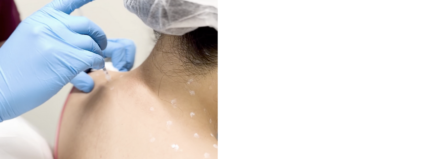 body toxin for shoulder and calves