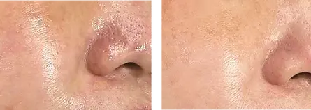 Jalupro peel.webp