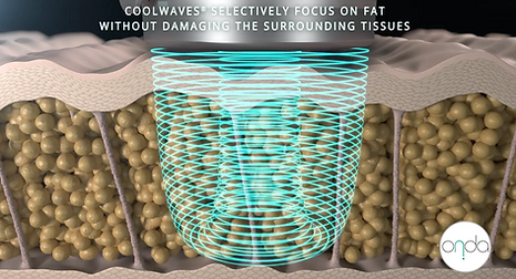 onda coolwave how it works2