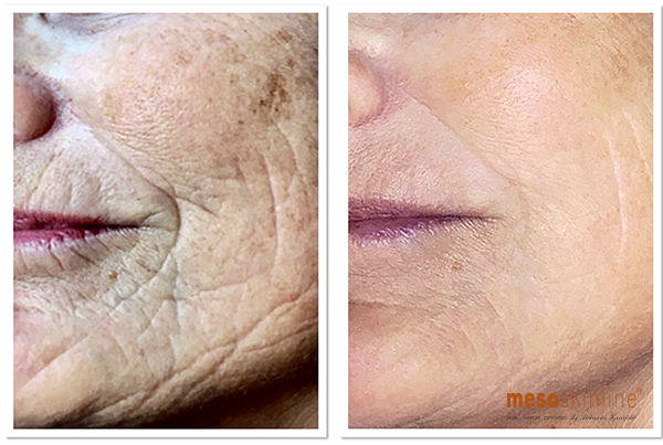 meso_cheek_lift_Clinic_Barsoe_Denmark