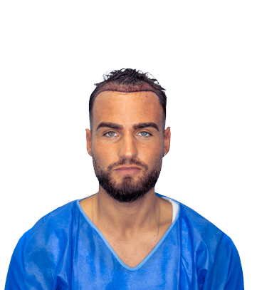 Transplante Capilar - Patrick Coelho