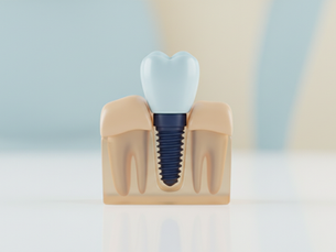 Why Dental Implants in Chennai Stand Out