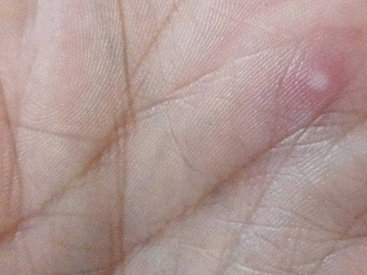 Varíola dos macacos pode apresentar lesões sutis e dificultar diagnóstico, dizem médicos