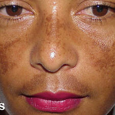 melasma-3.jpeg
