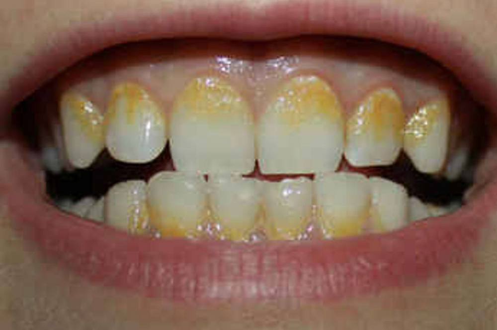 Certificate Plaque Indices & Periodontal Charting Dental Training Ltd